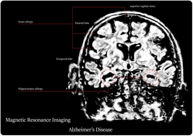 Alzheimer's disease MRI. Image Credit: Atthapon Raksthaput / Shutterstock